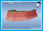 Overdenture