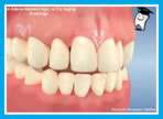 Ortodontik tedavide..